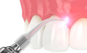 Dental Laser Treatment