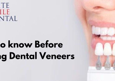 Things to know Before Considering Dental Veneers