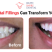 How Dental Fillings Can Transform Your Smile