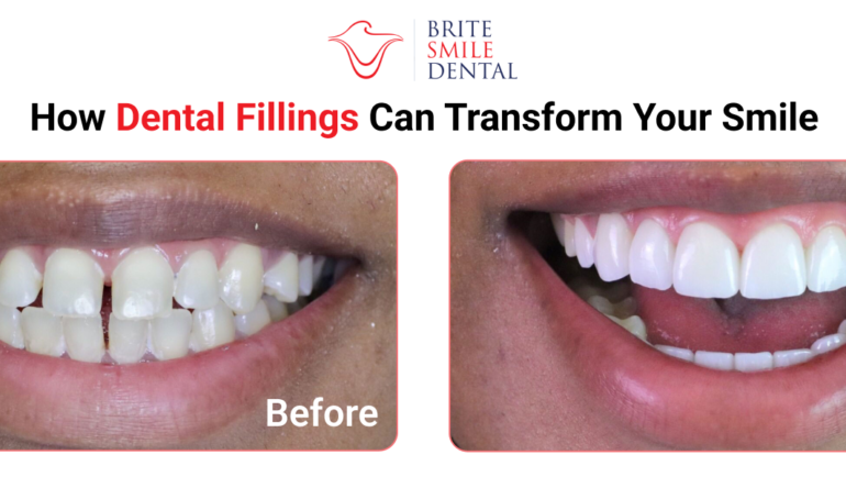 How Dental Fillings Can Transform Your Smile