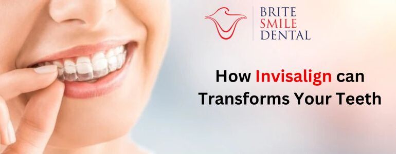 How Invisalign can Transforms Your Teeth – A complete understanding to the process