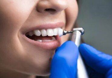 How to Care for Dental Veneers