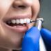 How to Care for Dental Veneers