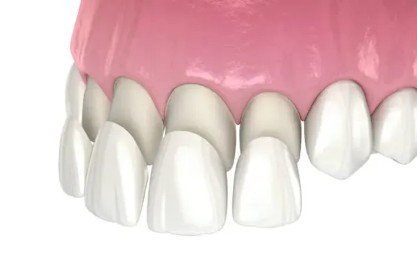 Dental-Veneers-Brite-Smile-Dental Dental Veneers Brite Smile Dental