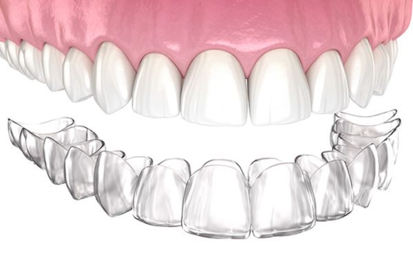 Invisalign Clear Aligners San Diego Clear Invisalign aligners used for orthodontic treatment at a San Diego dental office