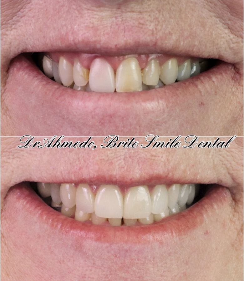 Before dental crowns showing worn and discolored front teeth at Brite Smile Dental