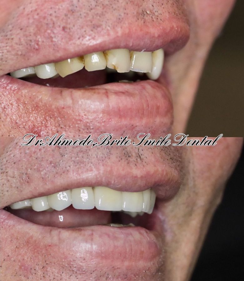 Full Mouth Rehab Before & After