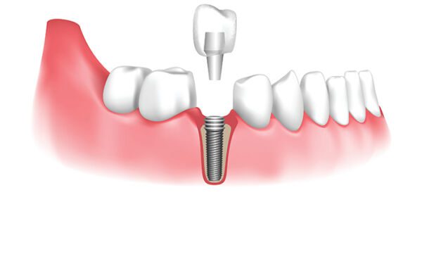 Dental Implants in San Diego