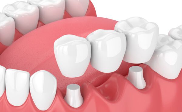 Fillings, Crowns & Bridges in San Diego Fillings, Crowns & Bridges in San Diego