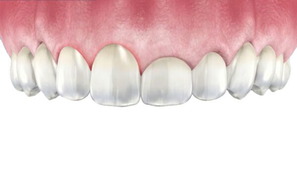 Gingivoplasty in San Diego CA