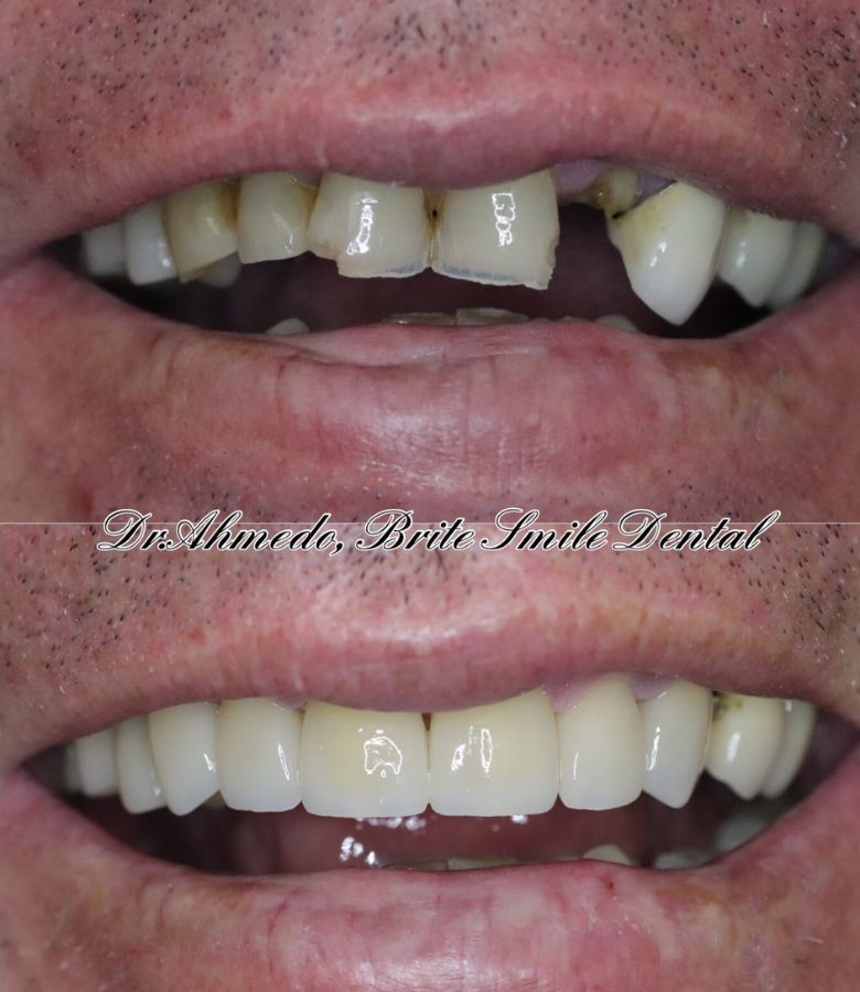 Full Mouth Rehab Before & After