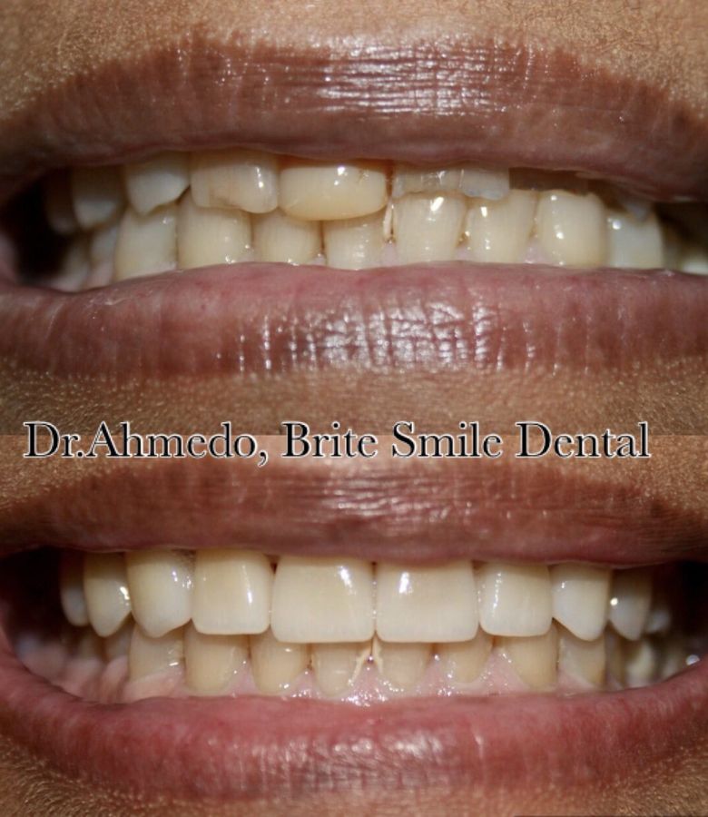 Full Mouth Rehab Before & After