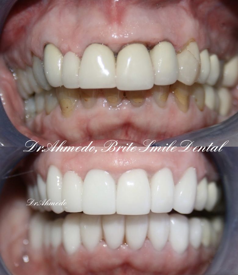 Full Mouth Rehab Before & After