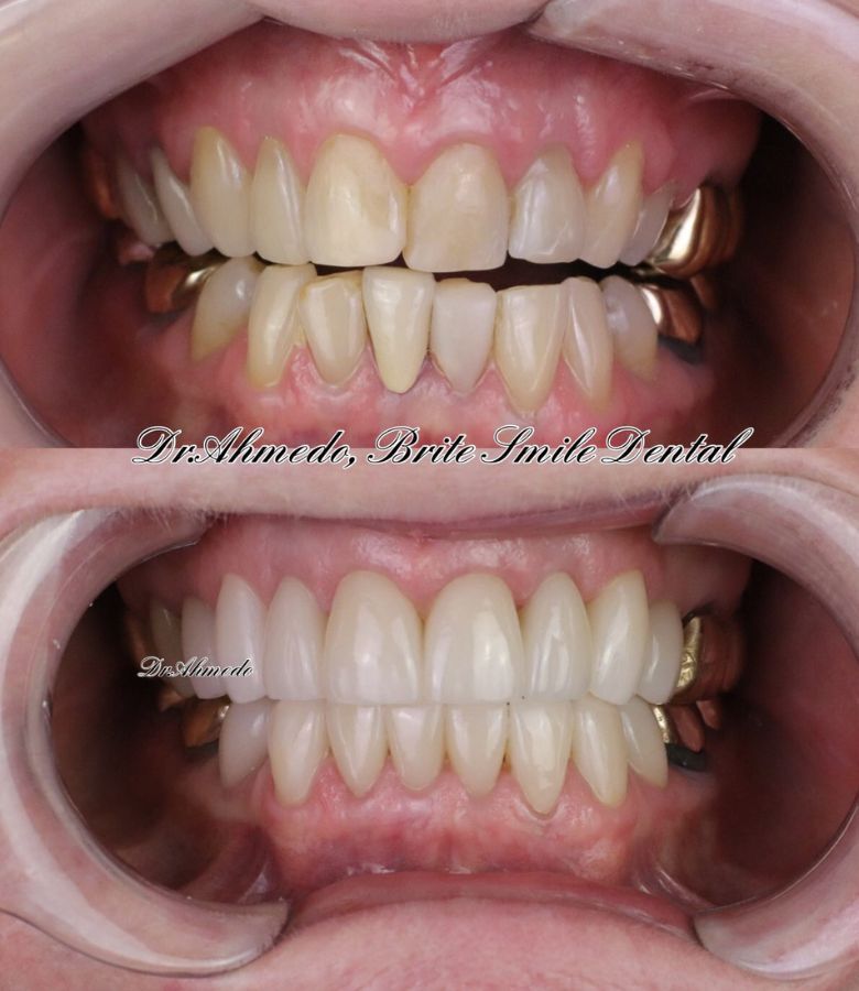 Full Mouth Rehab Before & After