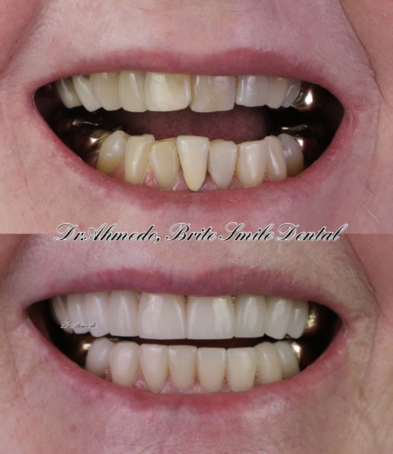Full Mouth Rehab Before & After