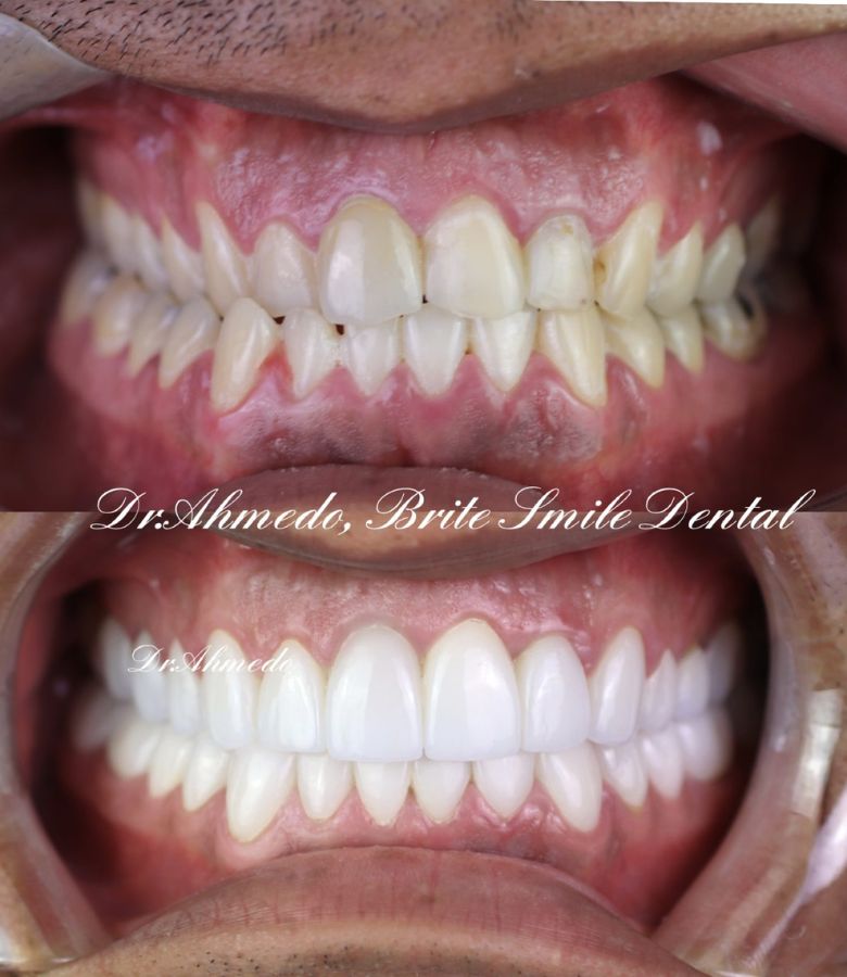Full Mouth Rehab Before & After