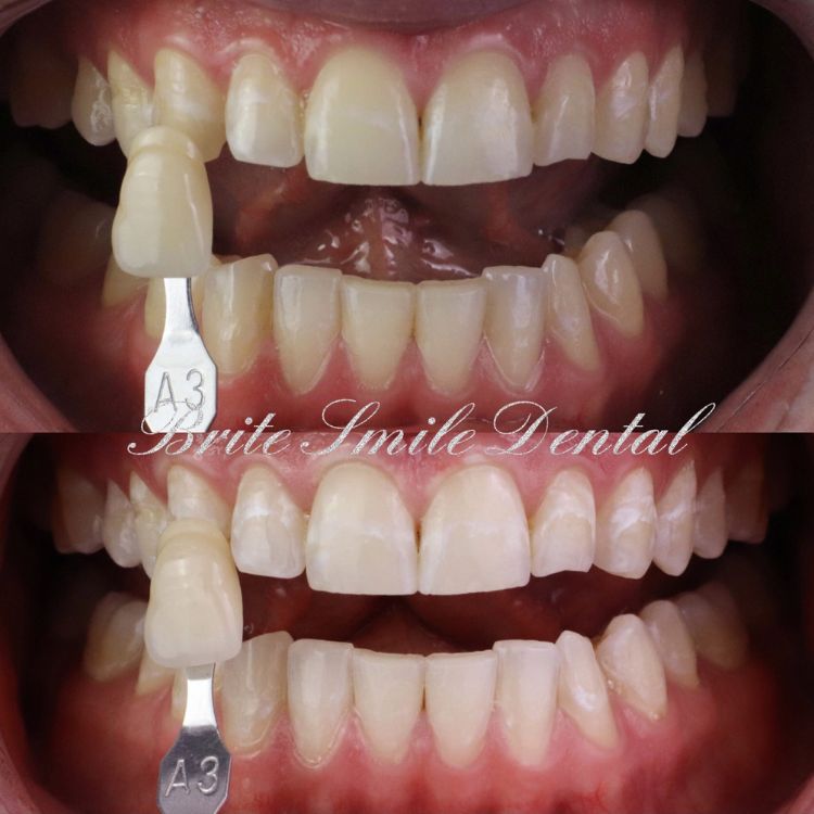 Teeth Whitening Before and After