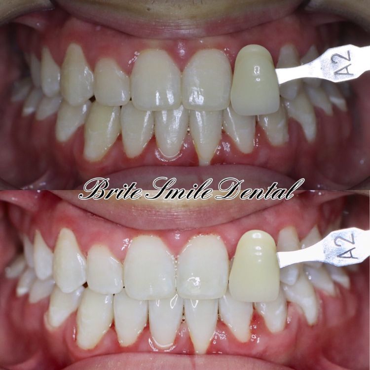 Teeth Whitening Before and After