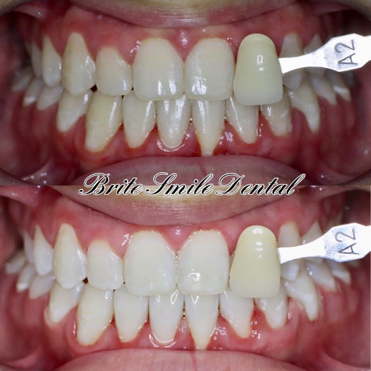 Teeth Whitening Before and After