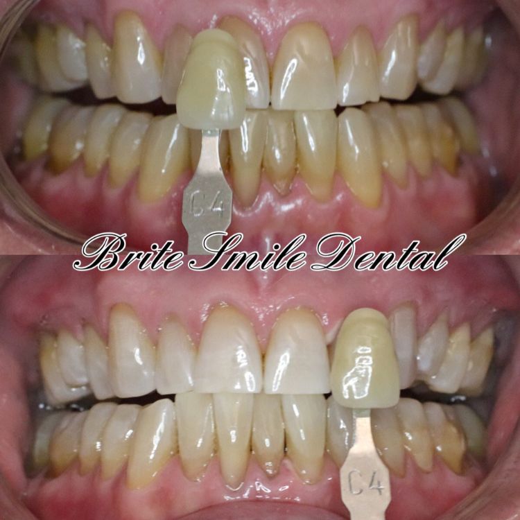 Teeth Whitening Before and After