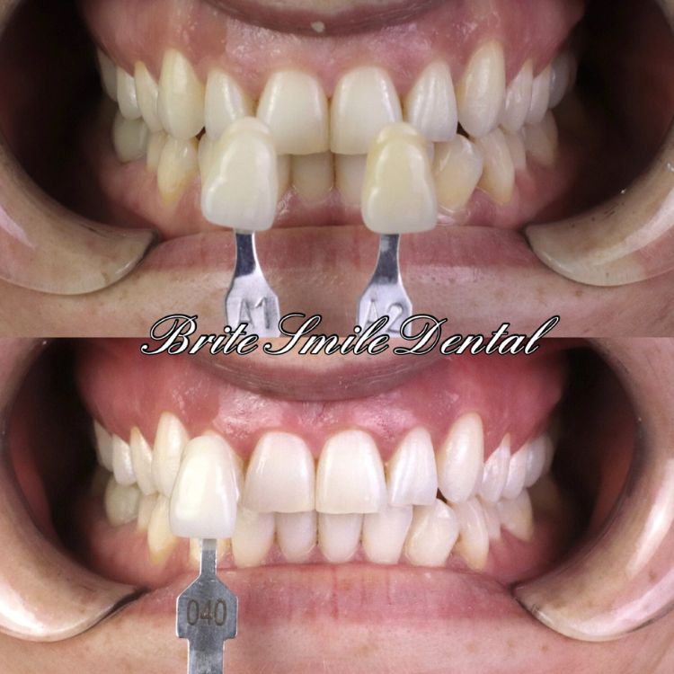 Teeth Whitening Before and After