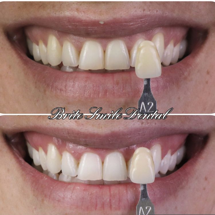 Teeth Whitening Before and After